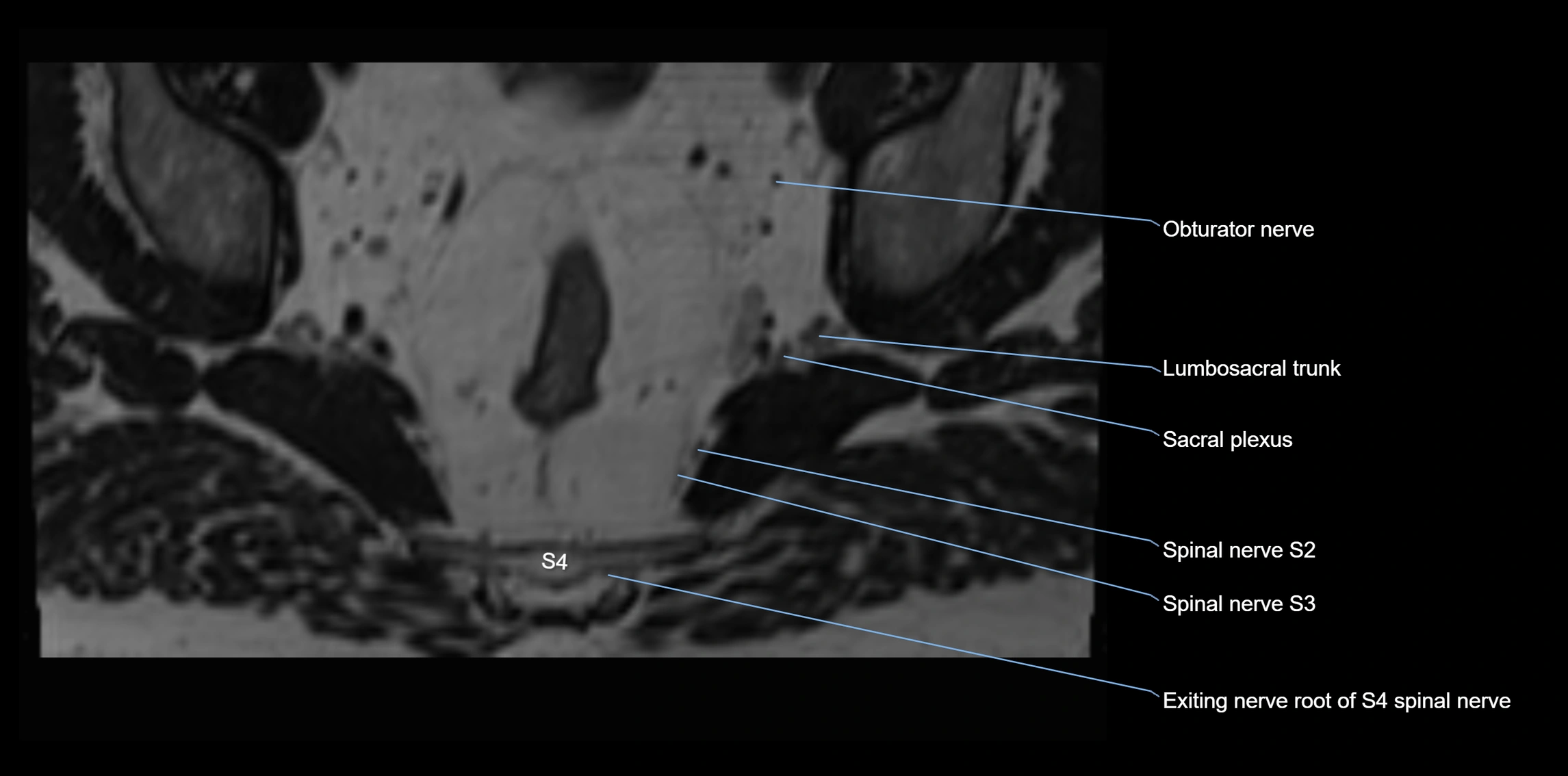 MR lumbosacral plexus axial cross sectional anatomy 3T  radiology  image-img-1008001-00102.webp